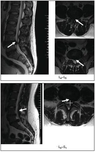 MRI przepukliny krążka kręgosłupa
