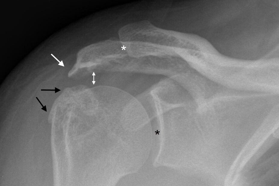 artroza stawu barkowego na zdjęciu rentgenowskim