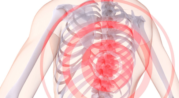 ból kręgosłupa z osteochondrozą piersiową